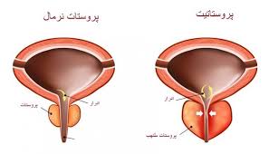 علائم خطرناک پروستات