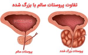 علائم خطرناک پروستات 